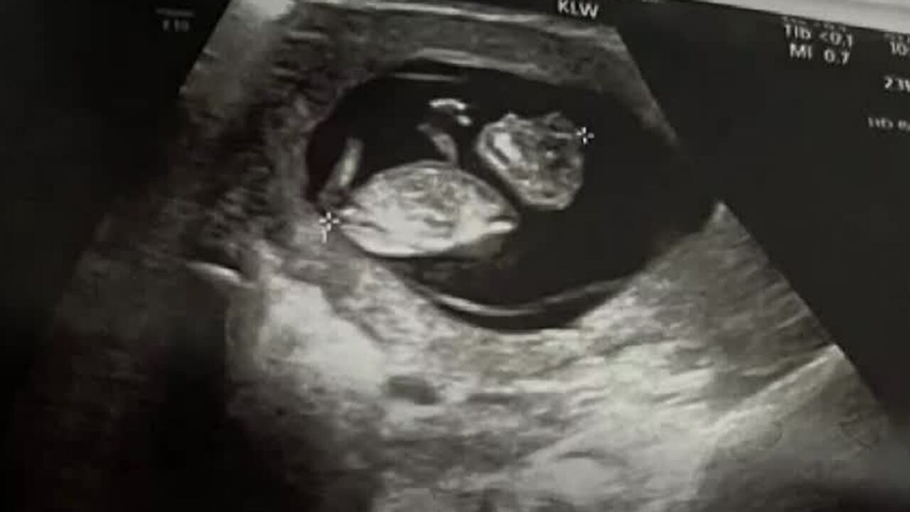 A Baton Rouge mother has a week to make an unthinkable decision - carry her baby to term even...